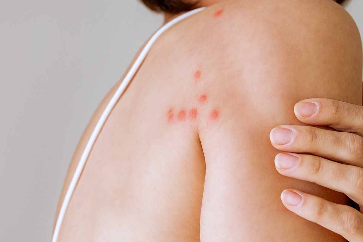 Bettwanzenstiche am Rücken einer Frau