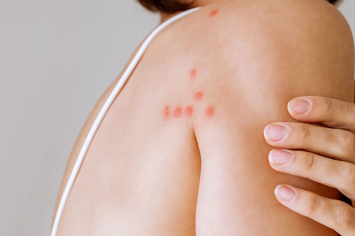 Bettwanzenstiche am Rücken einer Frau